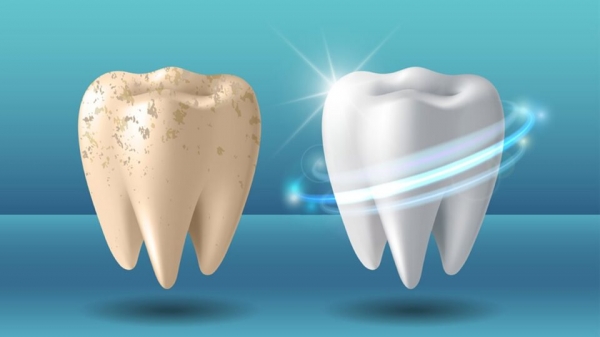 Стоматологи ответили, как отбеливание влияет на здоровье зубов