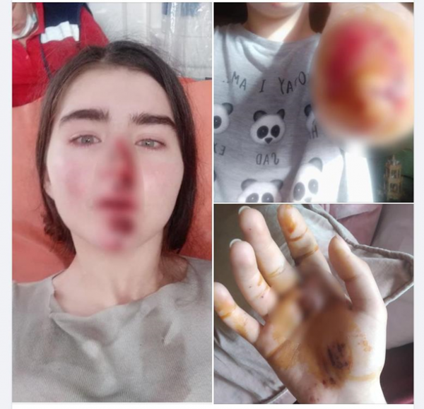 В Киеве девушка разбила лицо из-за сломанного самоката