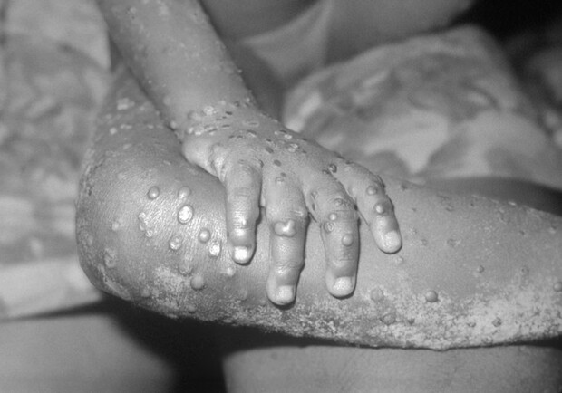 Обезьяна оспа: в Минздраве ответили на самые распространенные вопросы - 