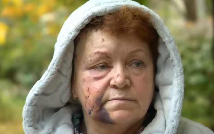 Олександра, яка постраждала від вибуху у Києві.